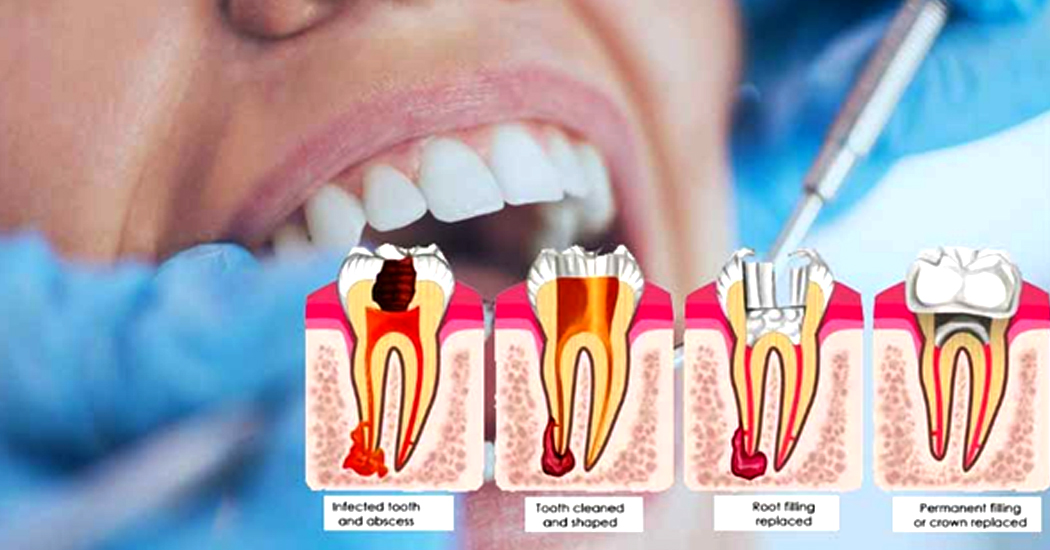 root canal treatment