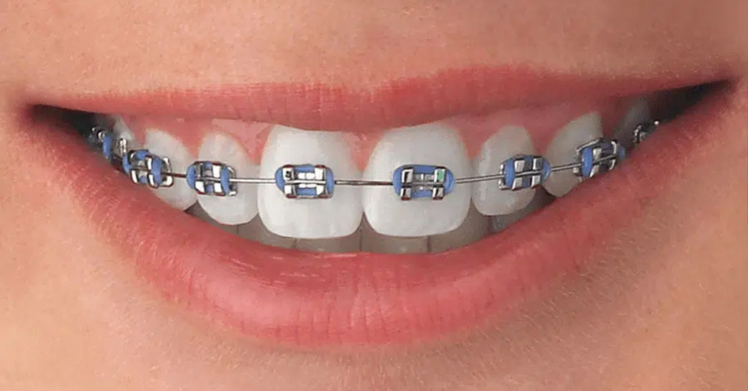 Braces