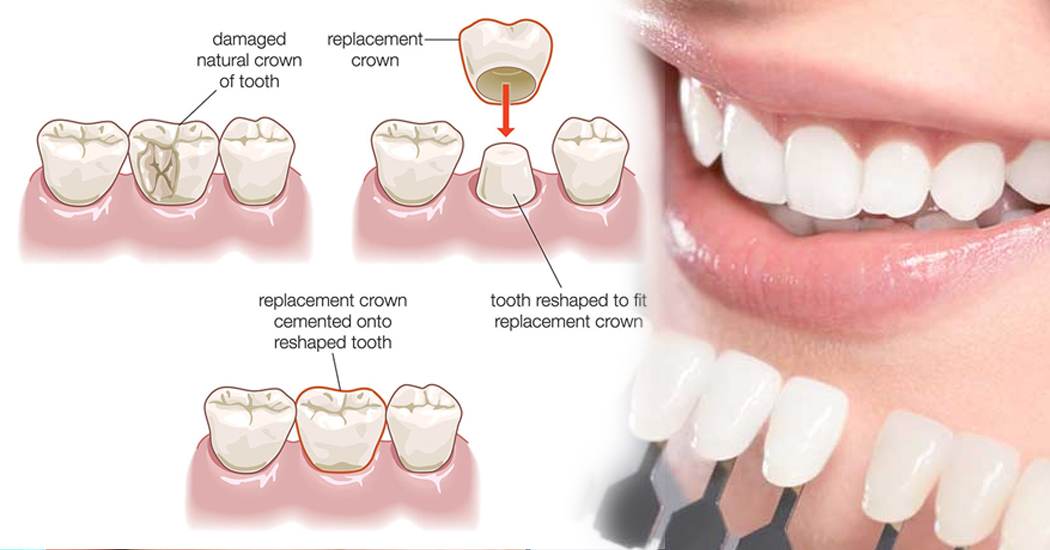 Teeth Capping