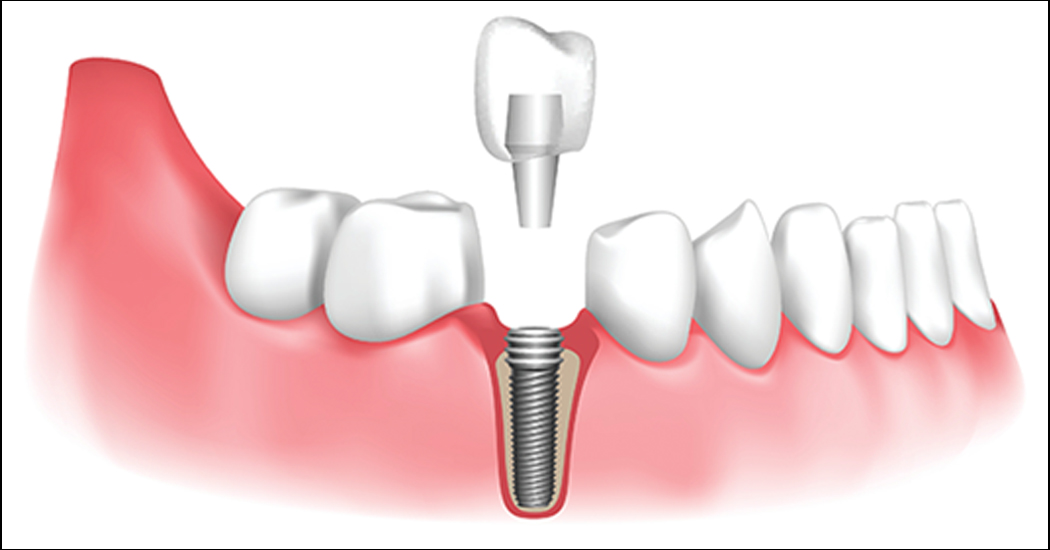 tooth-implant